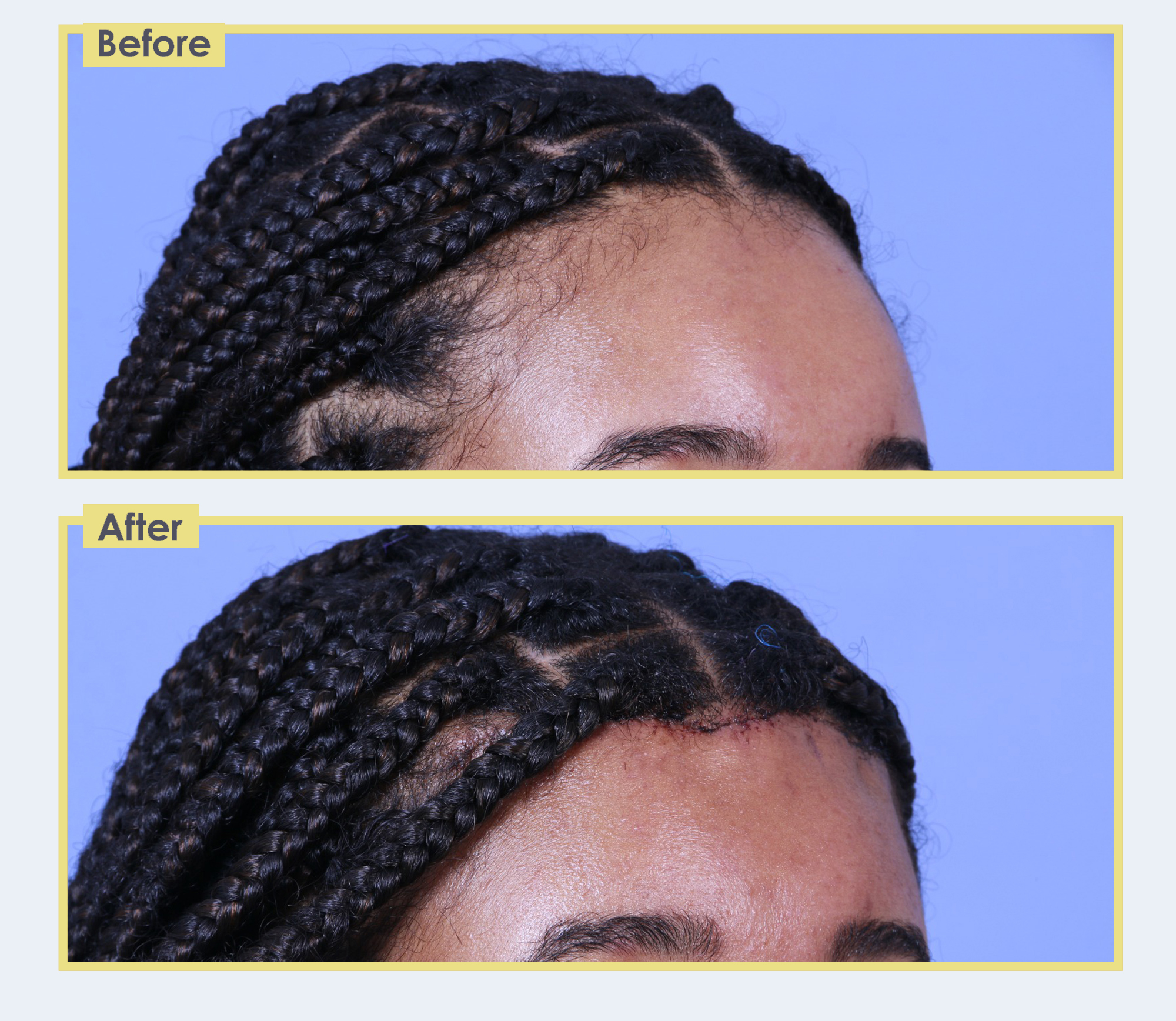 Gallery – Forehead Reduction